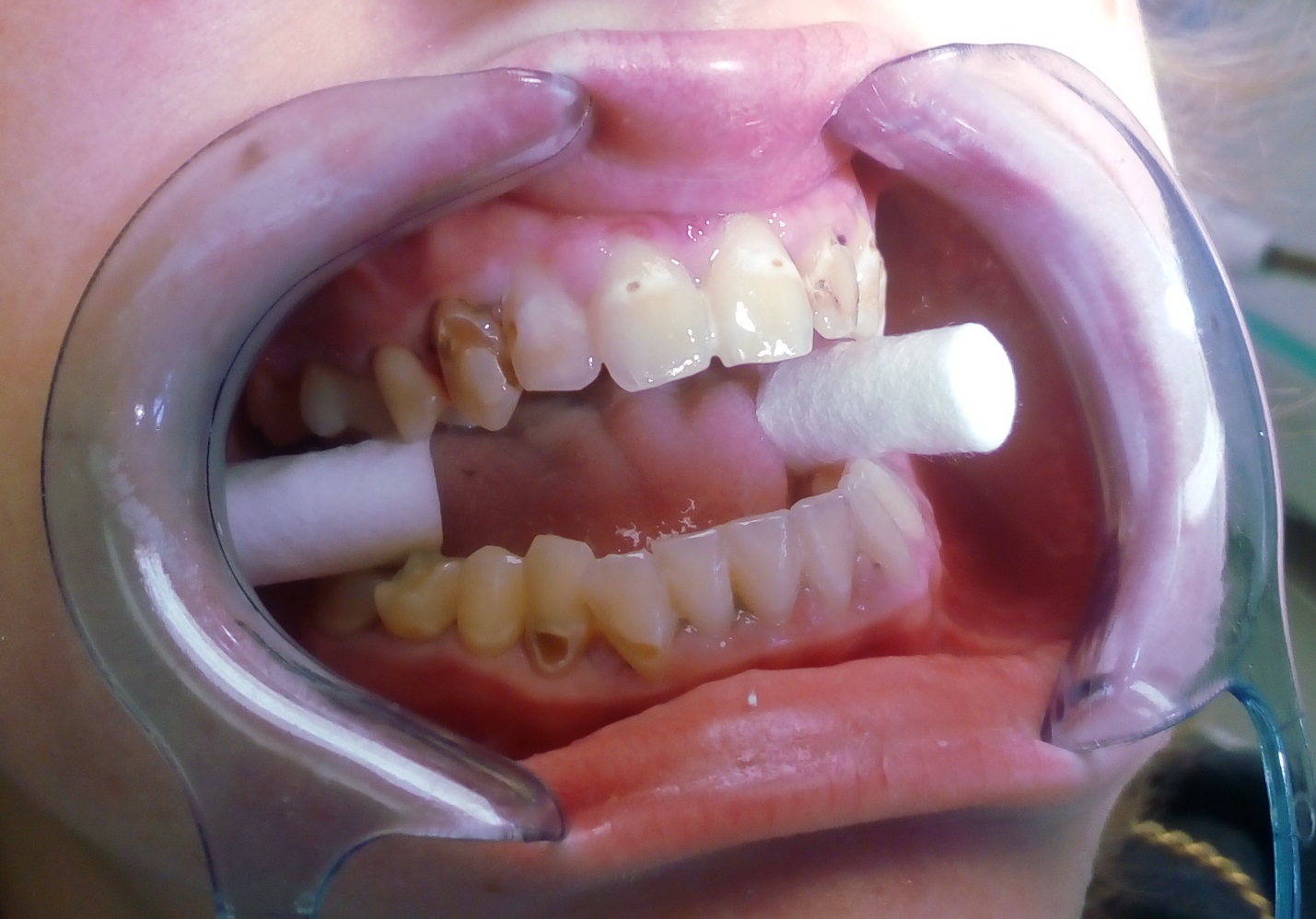 Stav před dentální hygienou a ošetřením frontálních zubů kompozitní výplní
