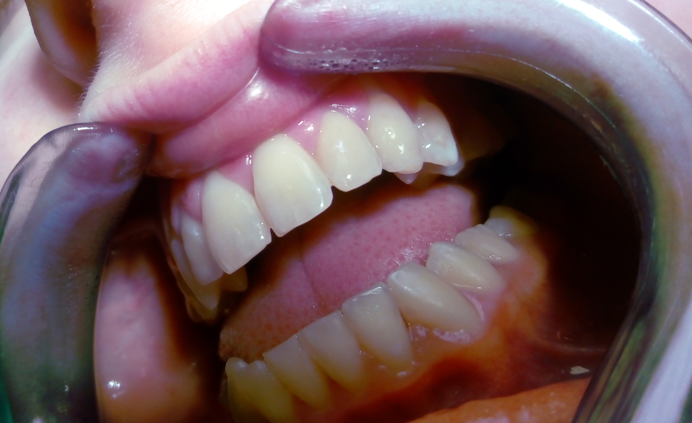Stav po dentální hygieně a ošetření frontálních zubů kompozitní výplní
